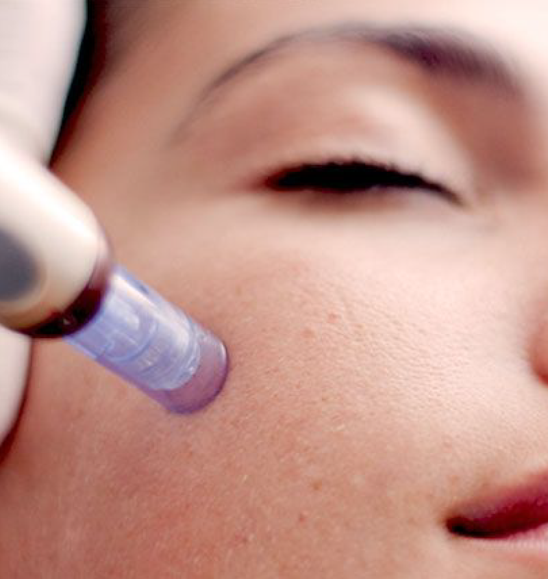 Collagen Induction Therapy