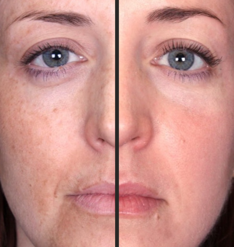 Lumecca Photofacial