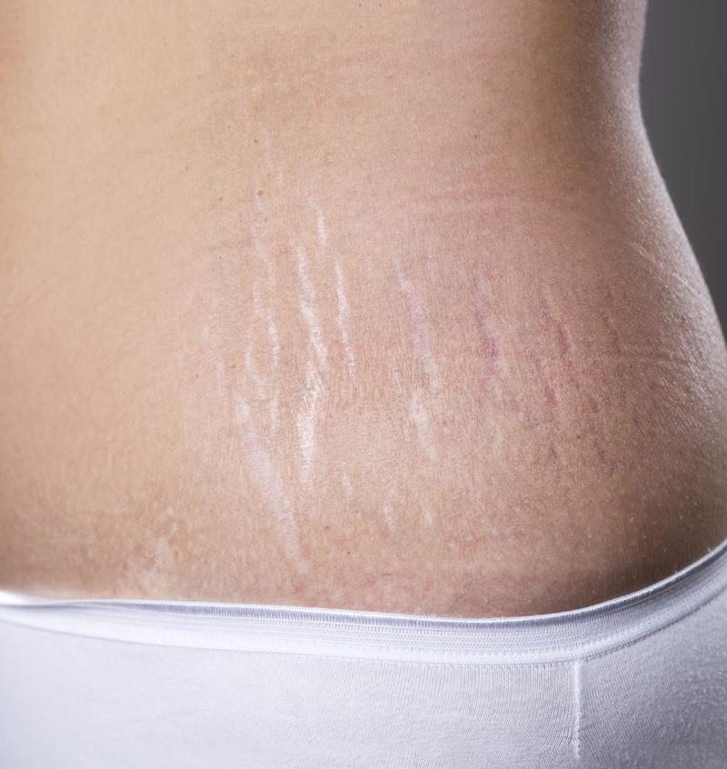 Stretch Mark & Scar Removal